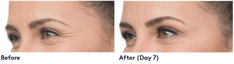 For temporary improvement of moderate to severe crowâ€™s feet lines, BOTOXÂ® Cosmetic is injected into theorbicularis oculi muscle surrounding your eyes.